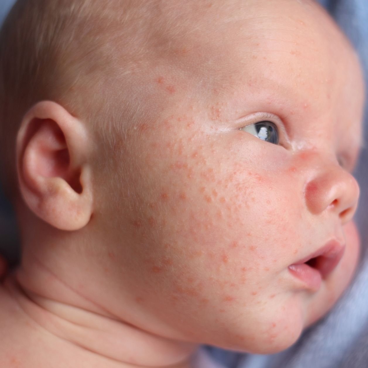 Acné du nourrisson : d'où proviennent ces boutons sur le corps de bébé ?