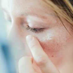 Granitos debajo de la piel: ¿por qué ocurre y cómo tratarlos?