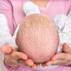 Crosta lattea: perchè compare sulla testa dei neonati? Come si toglie?