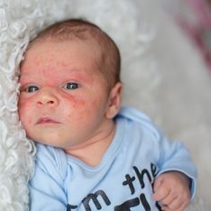 Puntini rossi sulla pelle del neonato: dermatite, acne neonatale o sesta malattia?