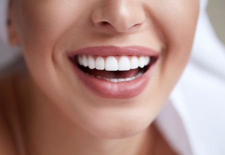 Facettes dentaires : faut-il vraiment se faire limer les dents pour la pose ?