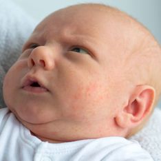 Brufoli neonato: cause e rimedi dell'acne neonatale