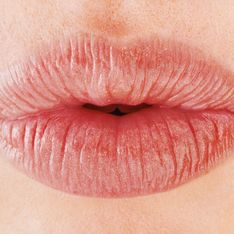 Labbra rifatte: pro e contro del trattamento volumizzante