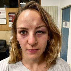 Violences conjugales : la championne de judo Margaux Pinot dévoile son visage tuméfié