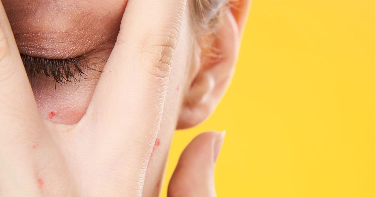 Esantema cos'è e come si cura questa manifestazione cutanea