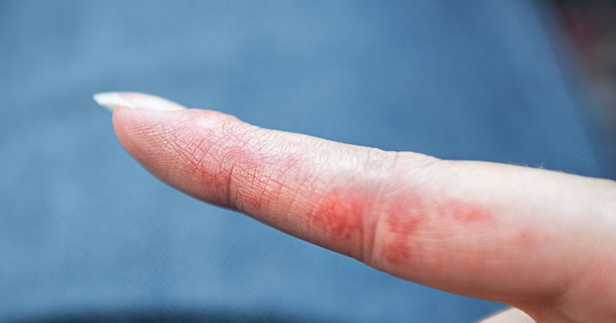 Disidrosi alle mani: le cause, i sintomi e il suo trattamento