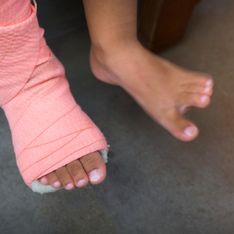 Che cos’è il piede torto? Cause, diagnosi, trattamento e prospettive