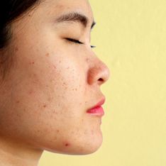Löcher in der Haut: Das hilft gegen große Poren und Pickelmale