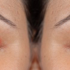 Il calazio: cause e sintomi di un disturbo dell’occhio