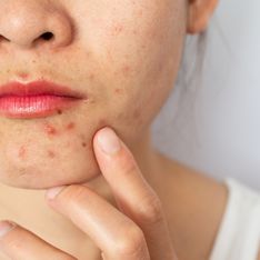 L’acne cistica: cause e possibili trattamenti