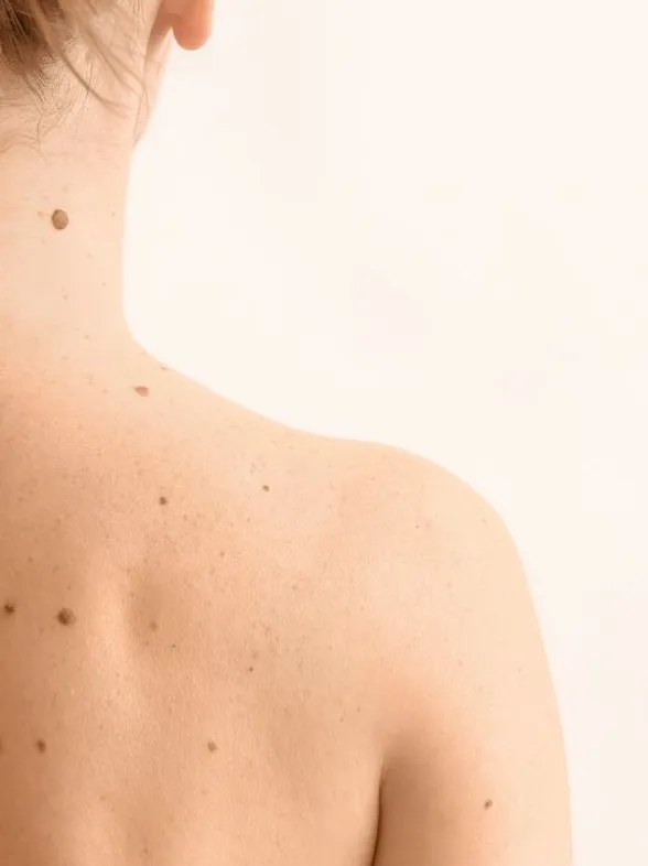 Cómo detectar lunares sospechosos y posibles melanomas con el método ABCDE
