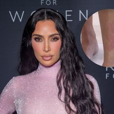 Kim Kardashian muestra su psoriasis en forma de corazón