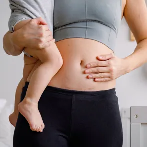 Cesárea: ¿Dolor eterno? Descubre por qué la cicatriz te sigue molestando