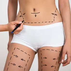 Todo lo que debes saber sobre la liposucción