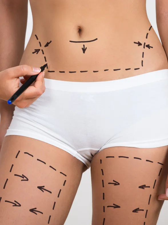 Todo lo que debes saber sobre la liposucción