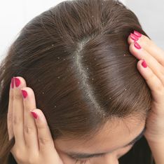 Cheveux : comment se débarrasser définitivement des pellicules ?