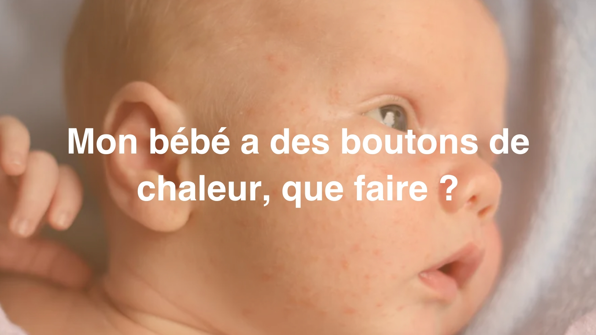 Boutons De Chaleur Chez Bebe Symptomes Causes Et Traitements