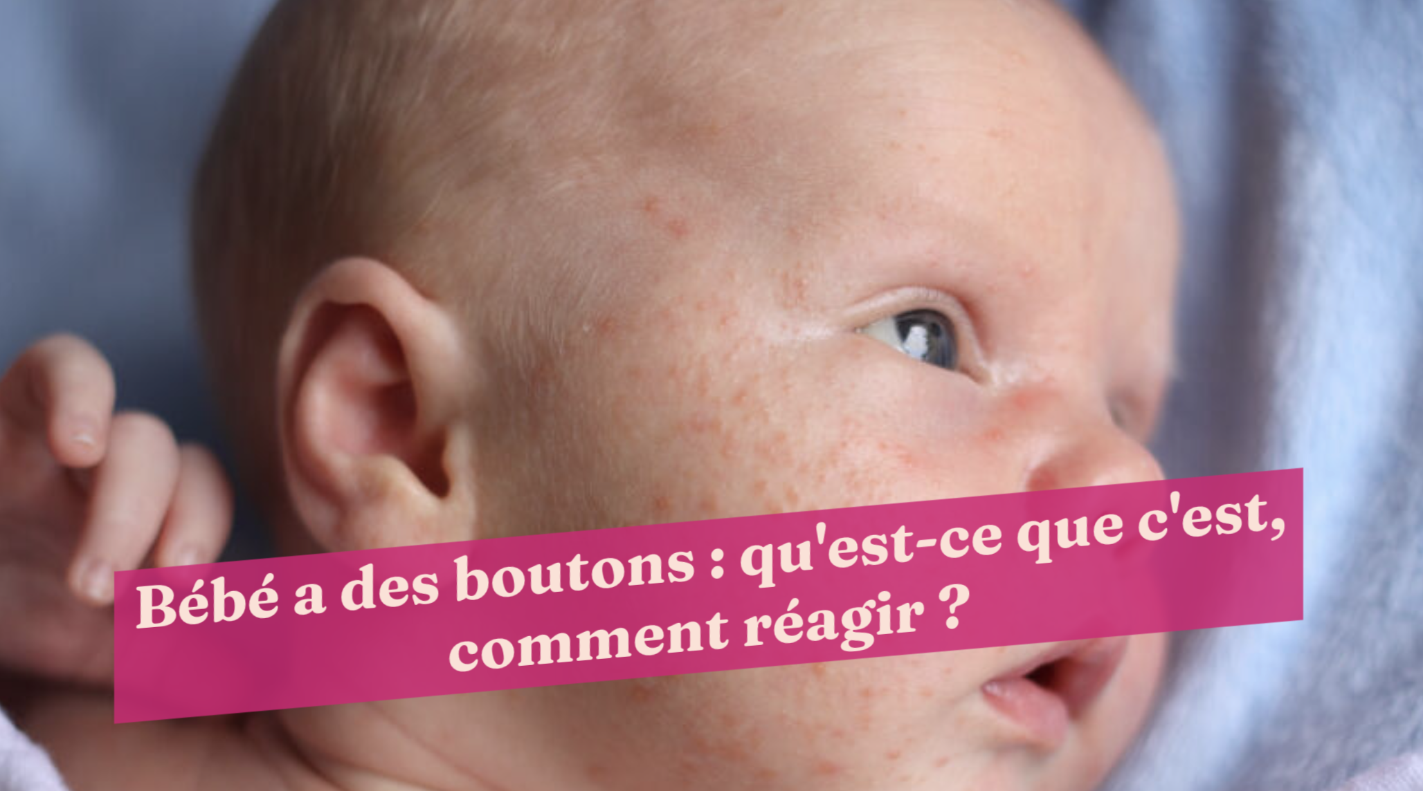Bebe A Des Boutons Qu Est Ce Que C Est Comment Reagir Bebe A Des Boutons Qu Est Ce Que C Est Comment Reagir