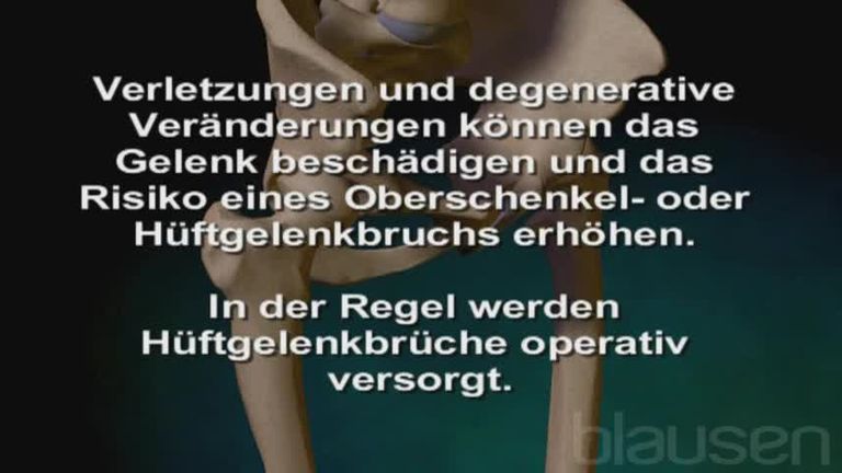 Huft Tep Kunstliches Huftgelenk Haufiges Ersatzteil Onmeda De