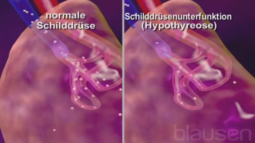 Schilddrusenuberfunktion Hyperthyreose Symptome Ernahrung