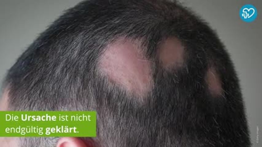 Haarausfall Durch Hormone Wann Kann Haarausfall Bei Frauen Und Mannern Hormonell Bedingt Sein Onmeda De