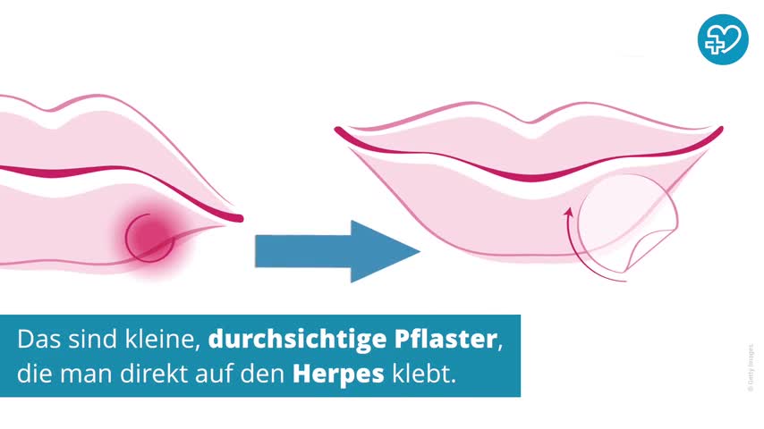 Lippenherpes Herpes Labialis Vorbeugen Behandeln Onmeda De
